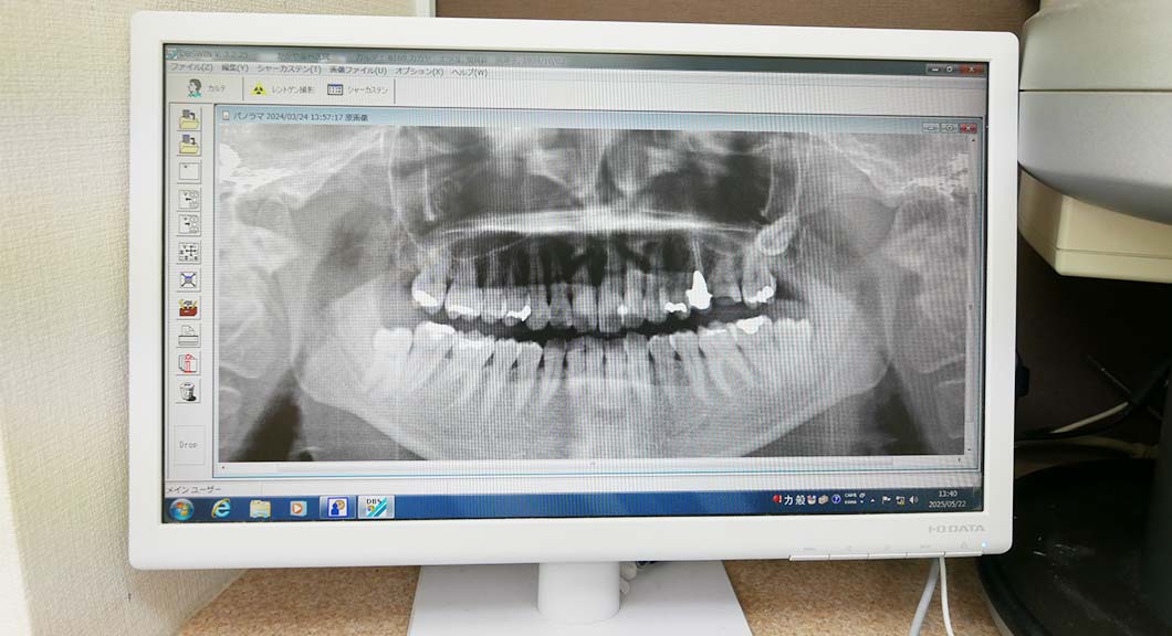 デジタルレントゲン